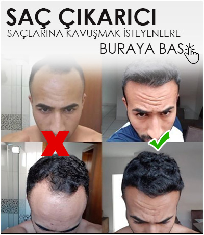 Saçlarım çıksın